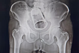 MKCG surgeons operate out steel glass from the rectum of patient