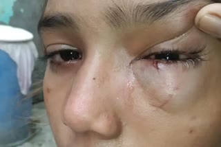 girl-injured-in-her-eye-after-allegedly-beaten-by-teacher-accused-held