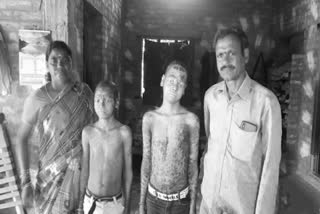 Children suffering with rare skin disease Ichthyosis in Challagarige