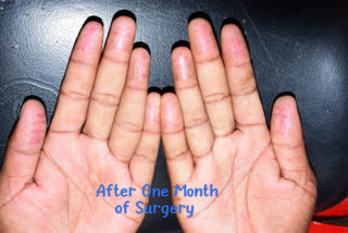 Finger prints surgery case