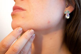 Pimple Solution News