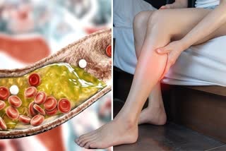 severe pain in these 3 areas of the body could be a symptom of high cholesterol