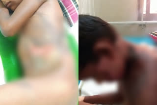 Teacher threw hot water on student in Karnataka  വിദ്യാർഥിയുടെ ശരീരത്തിൽ ചൂടുവെള്ളമൊഴിച്ച് അധ്യാപകൻ  രണ്ടാം ക്ലാസുകാരന്‍റെ ശരീരത്തിൽ ചൂടുവെള്ളമൊഴിച്ചു  സന്തേക്കല്ലൂർ ശ്രീഗണമതേശ്വര സീനിയർ പ്രൈമറി സ്‌കൂൾ  കുട്ടിയുടെ മേൽ തിളച്ച വെള്ളമൊഴിച്ച് അധ്യാപകൻ