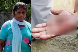 idukki stray dog attack old woman injured  idukki stray dog attack  64 കാരിയുടെ കൈയും നടുവും കടിച്ചുപറിച്ച് തെരുവുനായ  ഭീതിയിലായി ഇടുക്കി  idukki todays news  ഇടുക്കി ഇന്നത്തെ വാര്‍ത്ത  നിർമല സിറ്റി  നിർമല സിറ്റി പന്തലാട്ടിൽ  Nirmala City Panthalatt