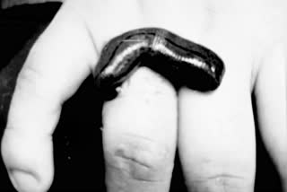 leech Therapy