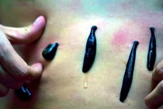 Leech Therapy Treatment