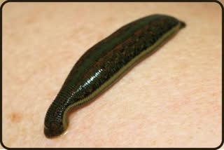 LEECH THERAPY