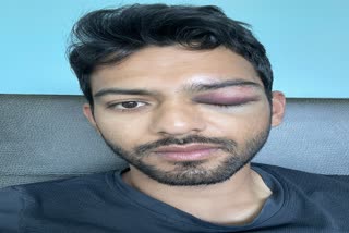 Unmukt Chand suffers eye injury in US