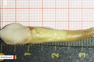 بڈگام میں ڈاکٹروں نے مریض کے منہ سے دنیا کا سب سے لمبا دانت نکالا