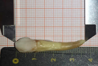 World's 'longest' tooth extracted in central Kashmir