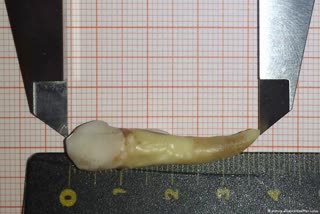 કાશ્મીર: દર્દીના મોંમાંથી વિશ્વનો સૌથી લાંબો દાંત કાઢવામાં આવ્યો