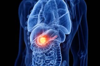 researchers reveal reason behind failures in process of detecting pancreatic cancer