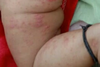 Rashes On Children Bodies