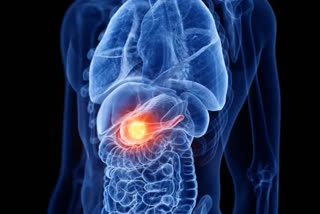 Pancreatic cancer diagnosis