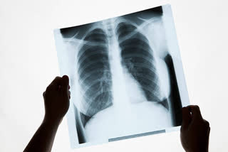 Researchers detect long-Covid's impact via simple chest X-rays