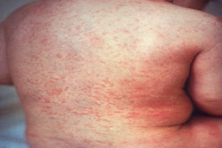 Mycelial rubella disease