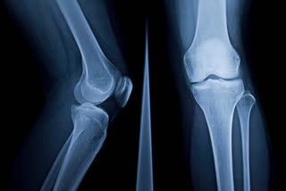 Total knee replacement in patients under 21 evaluated in new study
