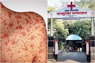 Measles Outbreak Mumbai