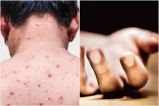 Measles Patients In Mumbai