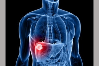 New AI blood test technology to detect liver cancer