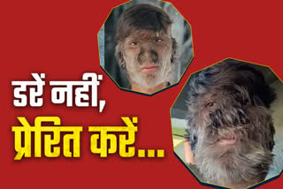 werewolf syndrome Etv Bharat