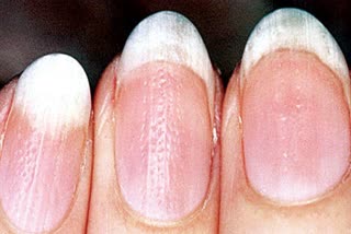 Your Nails Say About Your Health