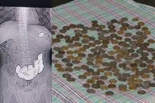 doctors-successfully-removed-187-coins-from-a-man-stomach