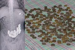 Man swallowed 187 coins
