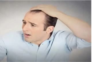 hair-transplant-is-effective-for-hair-loss-problem