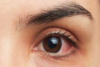 How to prevent conjunctivitis  Conjunctivitis disease  Pinkeye  what is Pinkeye  Conjunctivitis disease symptoms  Pinkeye symptoms  ചെങ്കണ്ണ് രോഗം  കോഴിക്കോട് ജില്ലയില്‍ ചെങ്കണ്ണ് രോഗം  ചെങ്കണ്ണ്  കണ്ണ് ദീനം  എന്താണ് ചെങ്കണ്ണ്