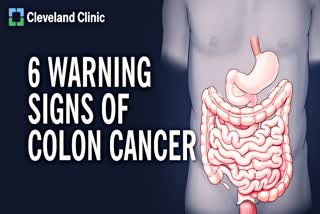 Colon Cancer can be Cured by timely treatment