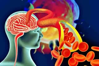 long-covid-side-effects-brain-stroke-increased-lung-problem-after-covid19