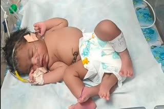 4-leg-girl-born-unique-baby-girl-born-in-Madhya Pradesh