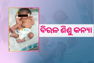 ୪ଟି ଗୋଡ ଥିବା ଶିଶୁ କନ୍ୟା ଜନ୍ମ ଦେଲେ ମହିଳା