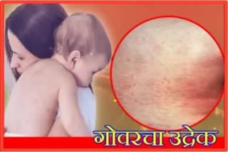 Guidance On Measles