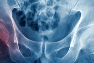 People suffering fractures in childhood vulnerable to breaking bones in old age, study finds