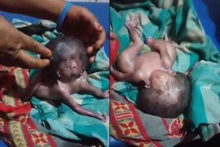 Baby Born With Four Hands