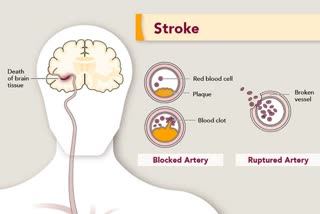 control stroke through diet
