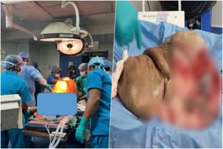46 KG Tumor removed by doctors from a 61 year old lady at a Private Cancer Hospital in Kolkata