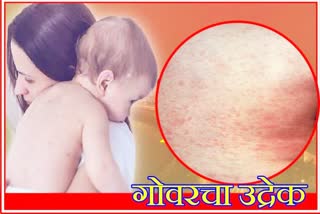 18th Death Due to Measles in Mumbai Today Taking Total Number of Suspected Patients to 5375