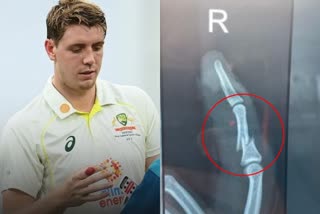 cameron green broken finger