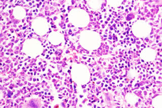 From chronic to aggressive, how blood cancer in some can progress as a disease : Study