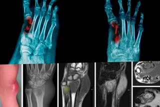 Osteomyelitis