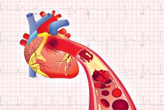 Successful operation of heart attack Cardiac arrest . cardiovascular diseases . polymer stent technique .angioplasty operation . heart diseases .