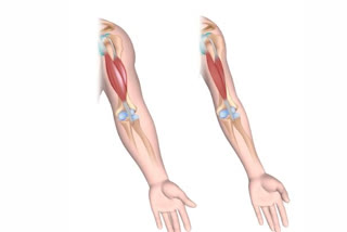 Duchenne Muscular Dystrophy