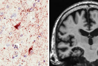 Researchers give insights into pathology of new type of dementia, LATE