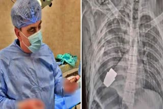 Ukrainian surgeon removes live grenade from soldier's chest