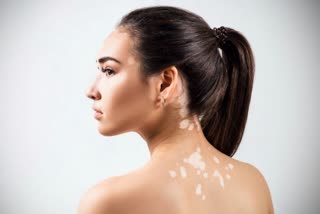 Vitiligo skin disorder News