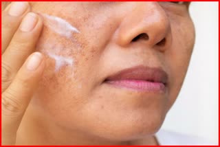 Pigmentation Home Remedy