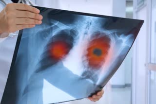 AI Can Detect Lung Cancer News